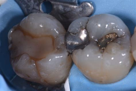 Replacing Old Fillings With Composite Resin Fillings