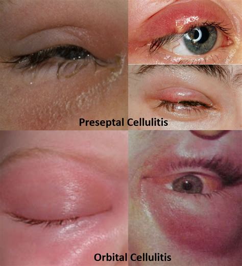 Eyelid Swelling Treatment Symptoms Causes Treatment And Prevention Of