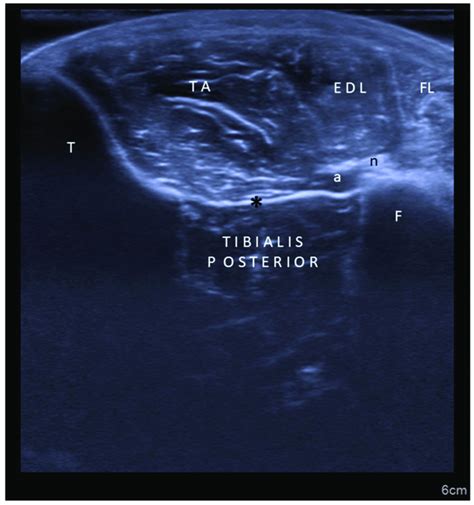 Ultrasound Imaging Axial View For Tibialis Posterior Muscle Ta