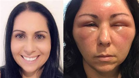If you do experience an allergic. Woman's allergic reaction to hair dye causes severe ...