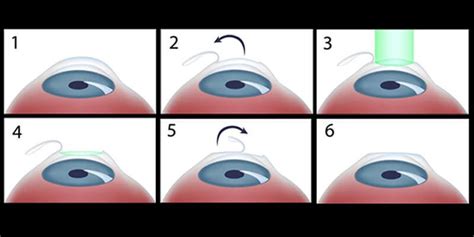 An Overview Of Lasik Surgery