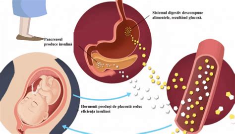 Diabetul Gestațional îngrijirea Pacientei Cu Diabet Gestațional Pagina De Nursing