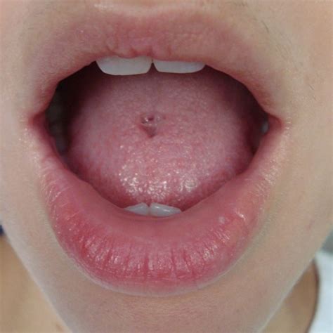 After a few days, remove the balls gently, soak it in alcohol for about ten minutes, and rinse them with water. Tongue retainer