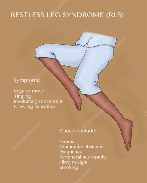 Restless Leg Syndrome Illustration Stock Image C0366302 Science Photo Library