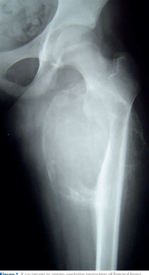 Figure 1 From Giant Aneurysmal Bone Cyst Mimicking Malignant Tumor