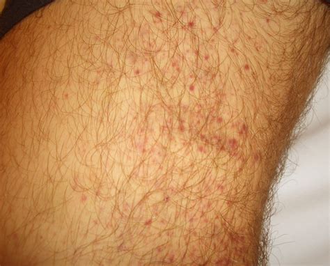 Purpura Pictures Causes Symptoms And Treatment