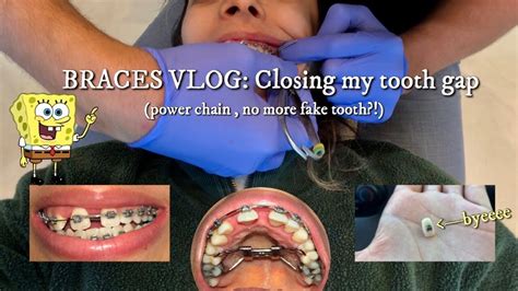 Closing My Huge Palatal Expander Gap No More Fake Tooth Braces Update Vlog Youtube