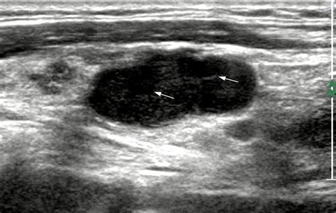 Lymphoma Cancerous Lymph Nodes In Neck Ultrasound Lymphoma Action