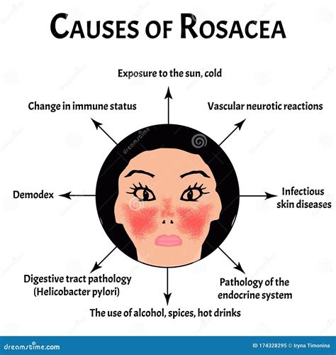 Causes Of Rosacea Rosacea Awareness Month Infographics Vector