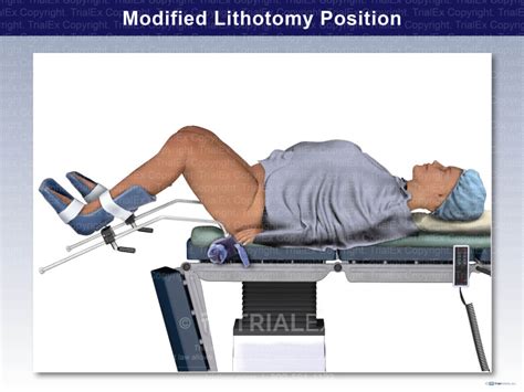 Modified Lithotomy Position Trial Exhibits Inc