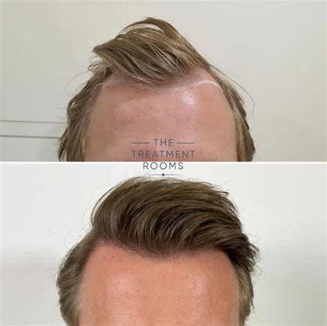 How Does A Hair Transplant Work An In Depth Guide Treatment Rooms London