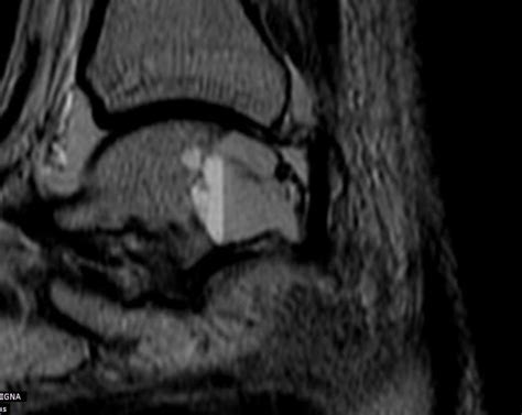 Aneurysmal Bone Cyst Of Talus Sumers Radiology Blog