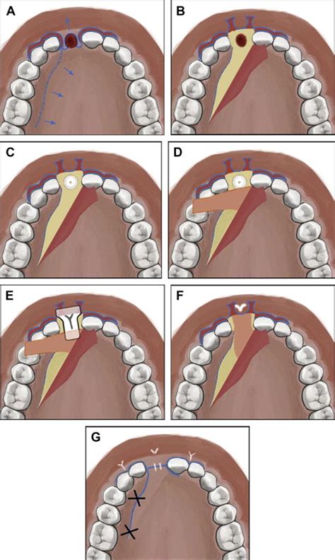 Palatal Flap Oral And Maxillofacial Surgery Clinics