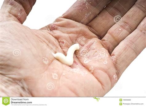 Há vários tipos de psoríase, como a gutata, invertida e ungueal. Psoríase, doença de pele foto de stock. Imagem de humano ...