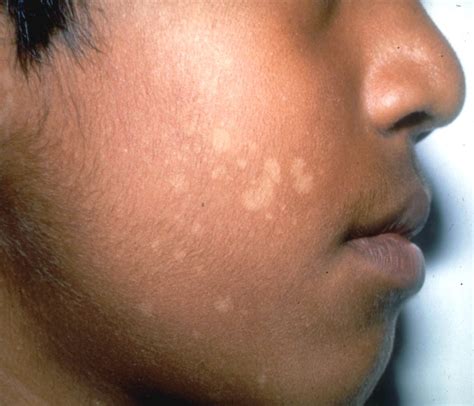 Skin Infection Joycelim Dermatology Skin And Laser Clinic