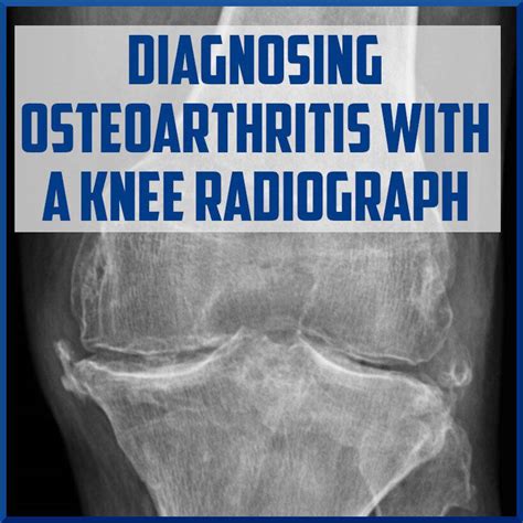 Diagnosing Osteoarthritis With Knee Radiograph Sports Medicine Review