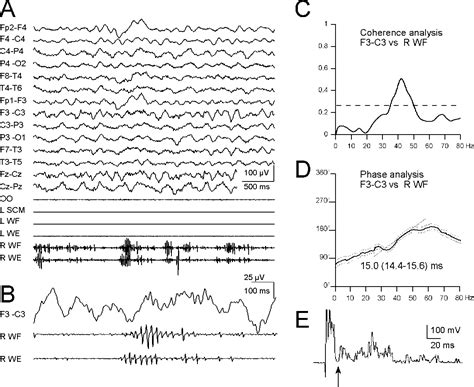 Figure 2 From High Frequency Rhythmic Cortical Myoclonus In A Long