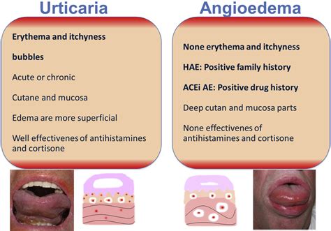 The Angiotensin Converting Enzyme Induced Angioedema Immunology And Allergy Clinics