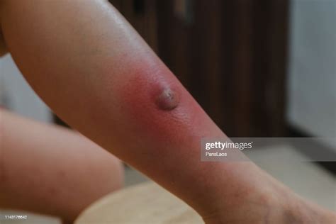 Skin Boil Furuncle Folliculitis On Leg High Res Stock Photo Getty Images
