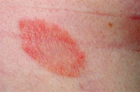 Herald Patch In Pityriasis Rosea Photograph By Dr P Marazziscience