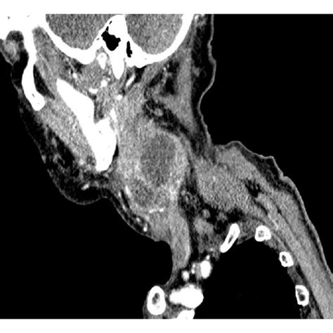 Ct Neck Sagittal And Coronal Images With Contrast Demonstrating