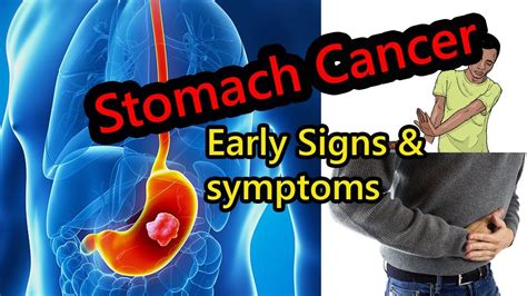 Around 7,000 people are diagnosed with it each year in the uk. Stomach Cancer Symptoms You Should Not Ignore - YouTube