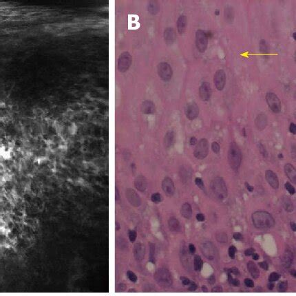 Confocal Laser Endomicroscopy Images Of Esophageal Superficial Squamous