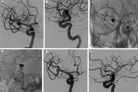 Neuroform Atlas Stent For Treatment Of Middle Cerebral Artery Aneurysms