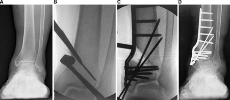 The Teramoto Distal Tibial Oblique Osteotomy Dtoo Surgical Technique