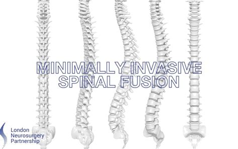 Minimally Invasive Spinal Fusion London Neurosurgery Partnership
