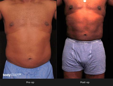 Male Body Contouring Before And After Photos Bodysculpt