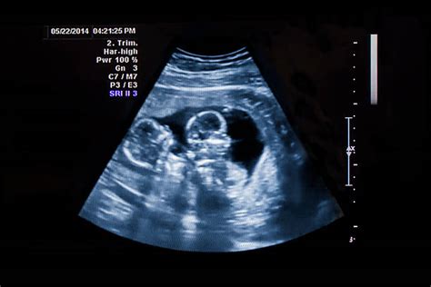 400 Ultrasound Twins Stock Photos Pictures And Royalty Free Images Istock