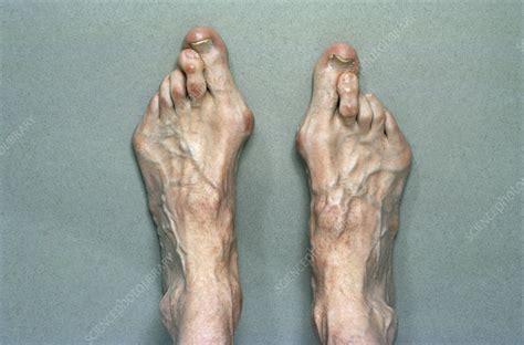 Marfan's syndrome - Stock Image M210/0015 - Science Photo Library