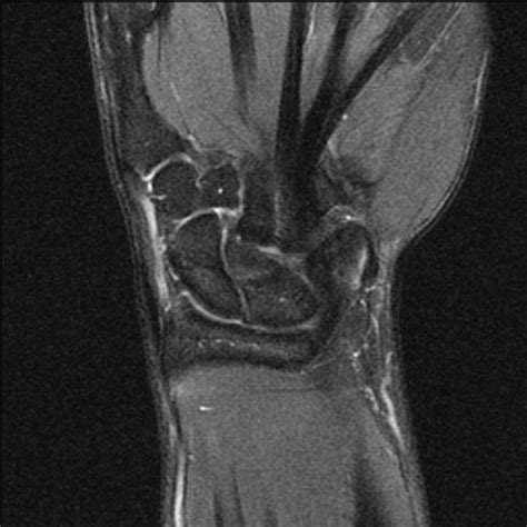 Normal Wrist 3t Mri Radiology Case
