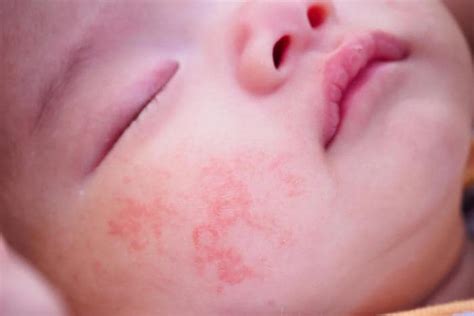 Dermatite Atopica Cause Sintomi E Cura Nei Bambini Portale Bimbo The