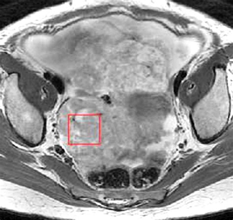 Advanced Ovarian Cancer Multiparametric Mr Imaging Demonstrates