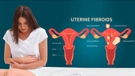 Uterus Saving Non Surgical Treatment For Fibroids