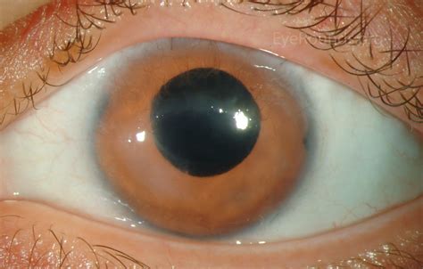 Ophtec 311 Iris Reconstruction Intraocular Lens For Congenital Aniridia