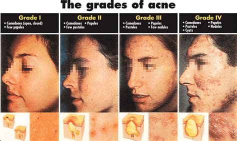 How Well Do You Know The Different Stages Of Acne Find Out