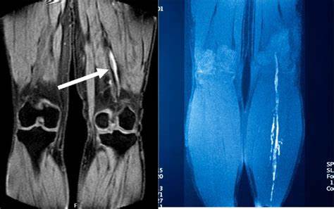 Диета для тромбоза глубоких вен CodLix - разработка программного обеспечения, нейросетей CodLix - разработка программного обеспечения, нейросетей Диета для тромбоза глубоких вен