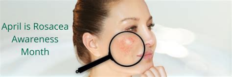 Rosacea Awareness Month With The Cosmetic Centre