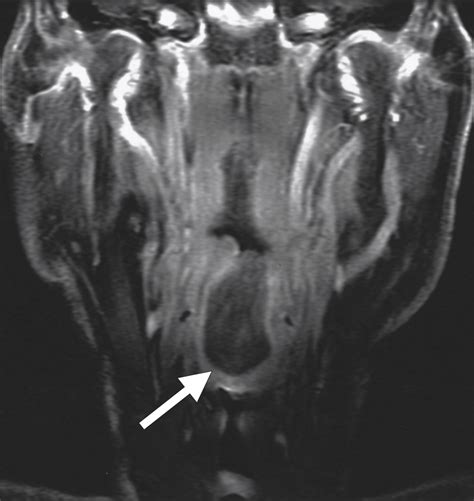Radiology Quiz Case 2 Jama Otolaryngologyhead And Neck Surgery The Jama Network