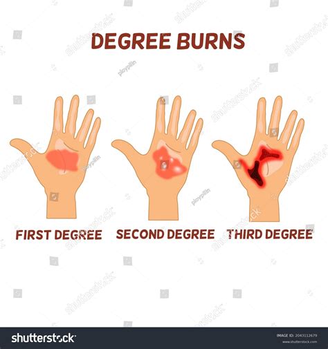 Degrees Burn 3 Palms Hand Show Stock Vector Royalty Free 2043112679