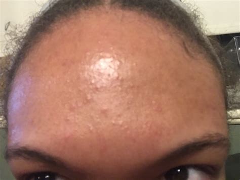 Small Bumps All Over Face Help General Acne Discussion