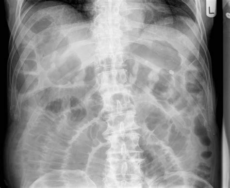 Small Bowel Obstruction Radiology Case Bowel