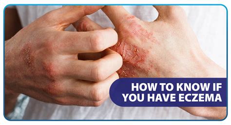 How To Know If You Have Eczema Unilab