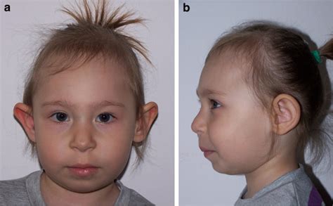 A B Facial Phenotype In Nbs Face A And Profile B Of A Girl