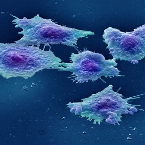 Learn more about the diagnosis, prognosis. Guardant enters race for liquid biopsy with colon cancer study