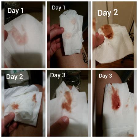 Bleeding Days After Hysteroscopy