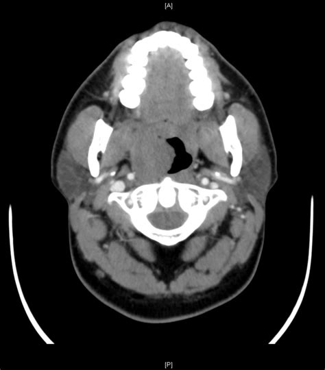 Lateral Pharyngeal Wall Myeloid Sarcoma As A Relapse Of Acute